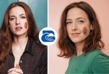 Chloe Radcliffe Birthmark