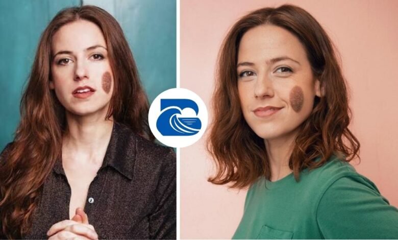Chloe Radcliffe Birthmark
