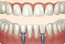 What to Expect During Implant-Retained Teeth Treatment 
