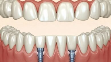 What to Expect During Implant-Retained Teeth Treatment