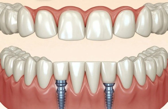 What to Expect During Implant-Retained Teeth Treatment 